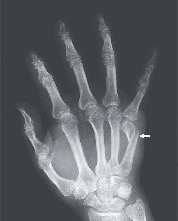 boxers fracture